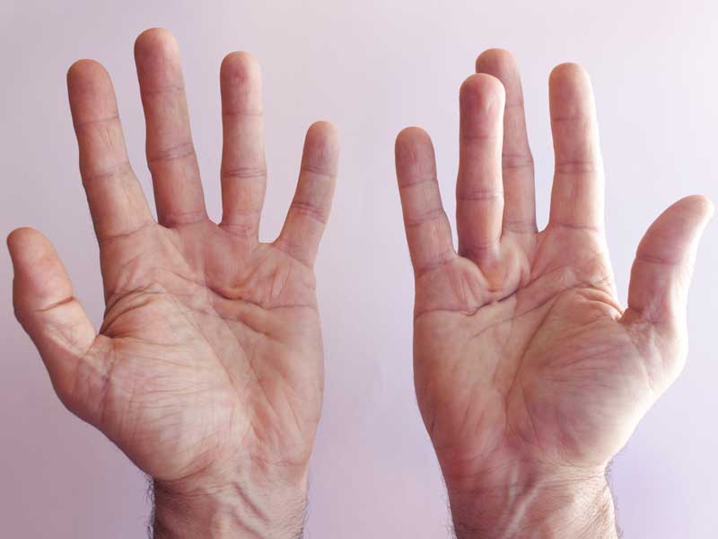 Hands of an man with Dupuytren contracture